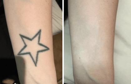 Tattoo-Removal-Before-and-After