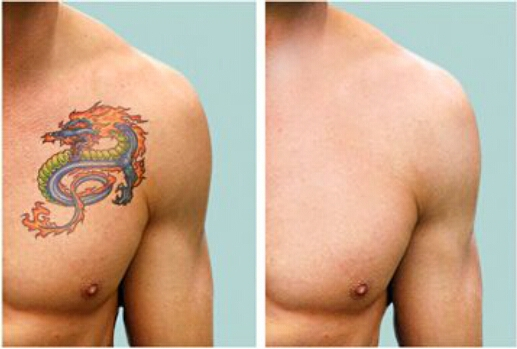 Tattoo Removal- Procedure, Risks, Cost All Under One Roof